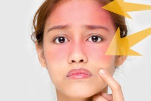 TẠI SAO BÔI KEM CHỐNG NẮNG BỊ NÓNG MẶT