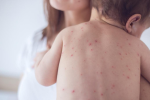 Cách phòng tránh bệnh sởi cho trẻ hiệu quả ba mẹ nên biết