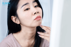 Lạm dụng corticoid: Vì sao da bị bào mòn và phục hồi thế nào?